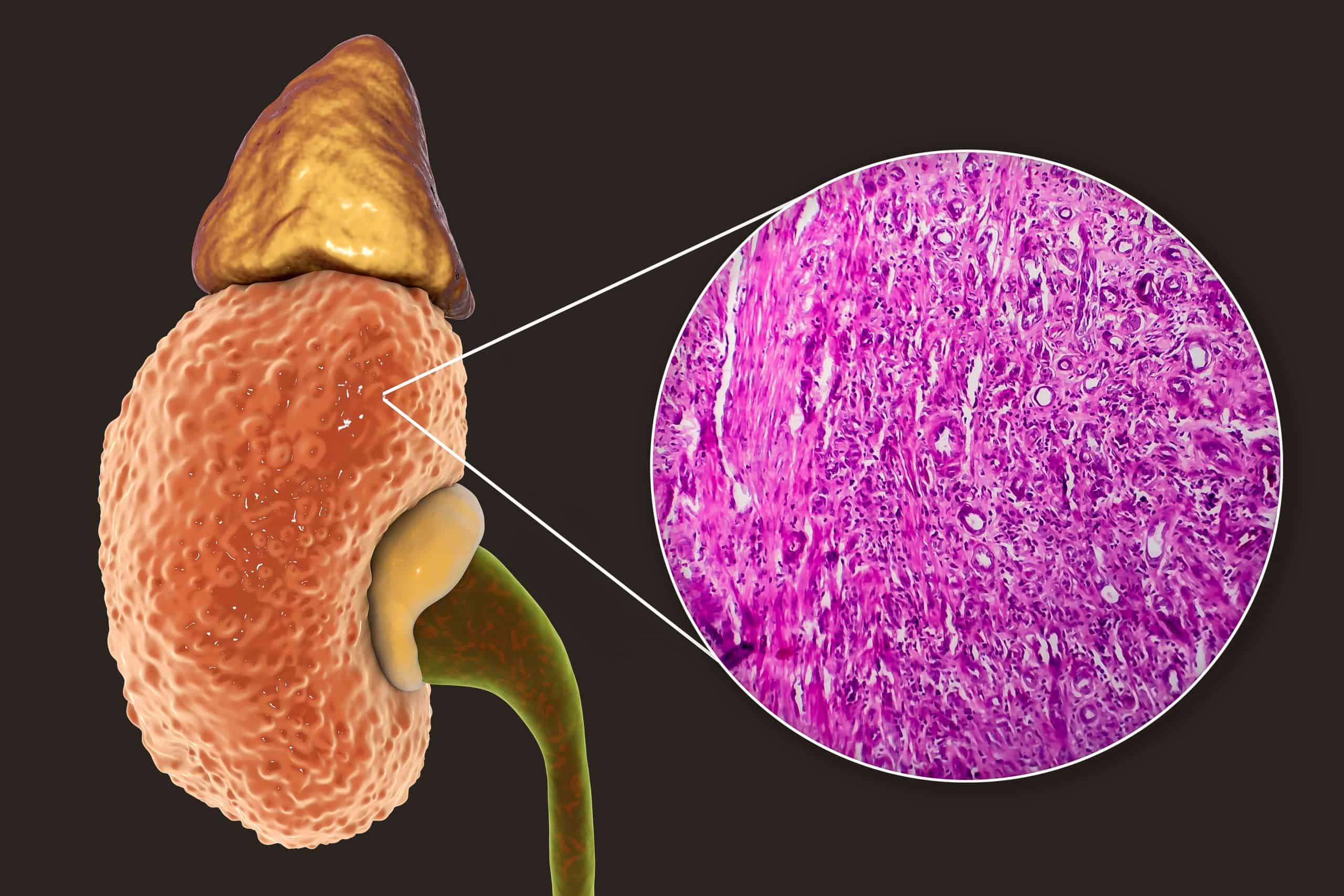 Glomerulonefritis uzrok simptomi liječenje Arz hr