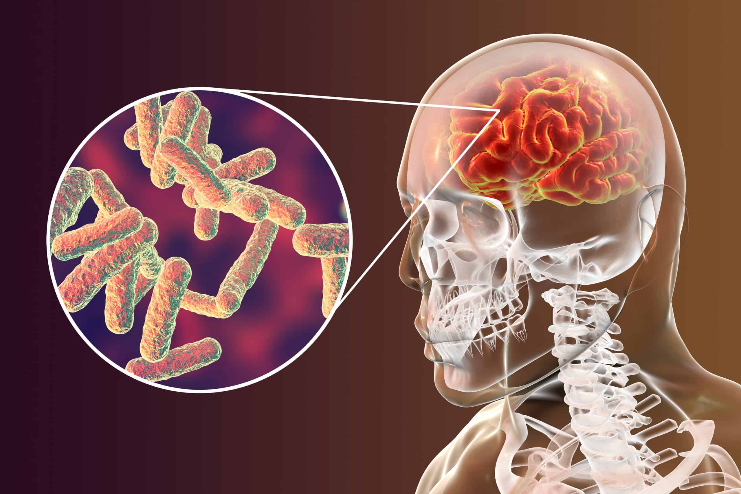 Meningitis Uzrok Simptomi Posljedice Lije enje Arz hr